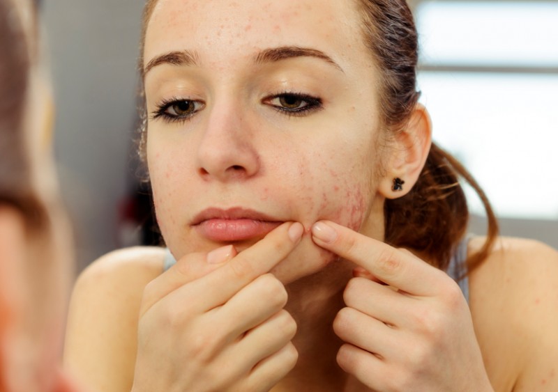 Dicas de Remédios Naturais Para Acne